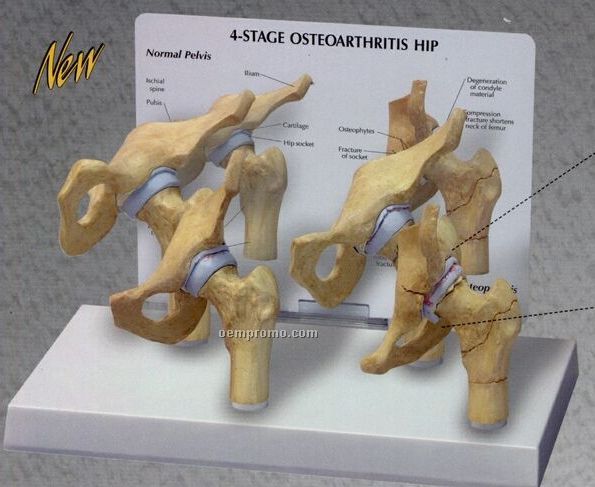 Anatomical 4 Stage Arthritic Hip Model