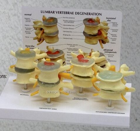 Anatomical 4 Stage Osteoporosis Vertebrae Model