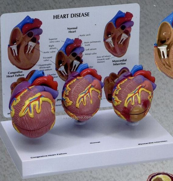 Anatomical 3 Piece Mini Heart Model Set (Normal + 2 Conditions)