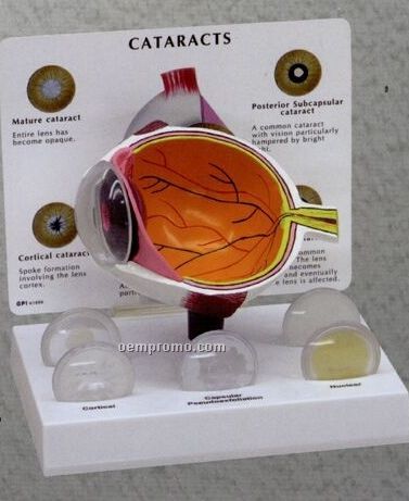 Anatomical Cataract Eye Model - 5"X3"X4" (Set Of 5)