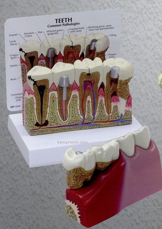 Anatomical Oversized Teeth Model W/ Pathologies