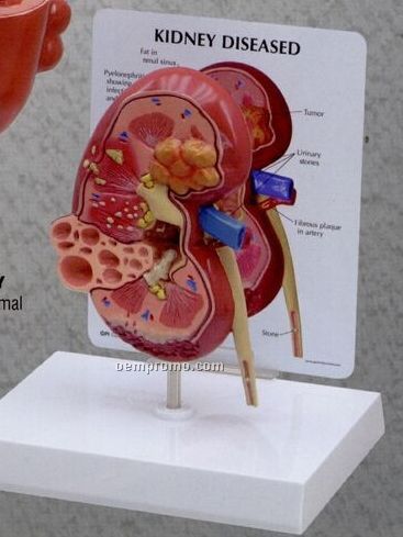 Anatomical 2 Sided Kidney Model (Normal/ Pathology)