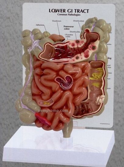Anatomical Colon & Gi Tract Model With Pathologies