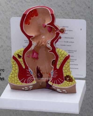 Anatomical Rectum Model With Pathologies