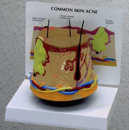 Anatomical Skin Acne Model